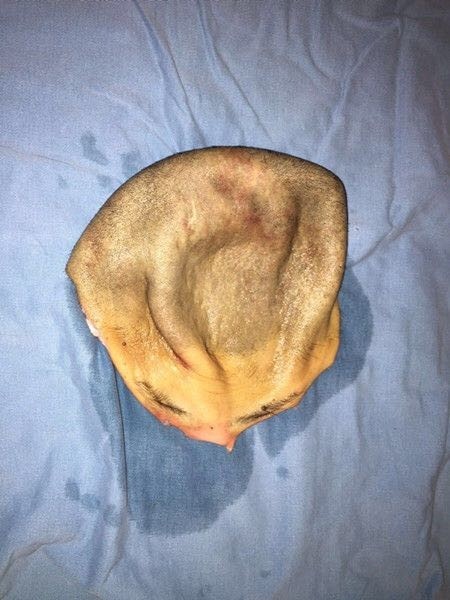 疼女子整张头皮被撕下来